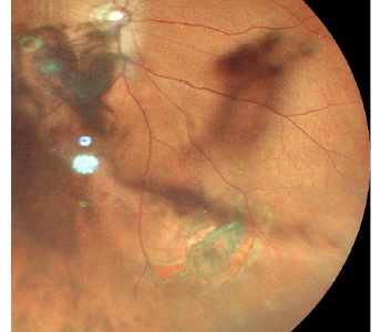 網膜裂孔、網膜剥離