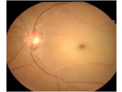 網膜中心動脈閉塞症