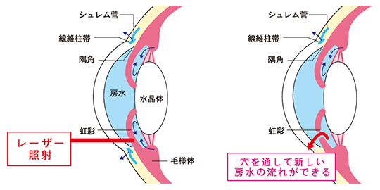 急性緑内障発作