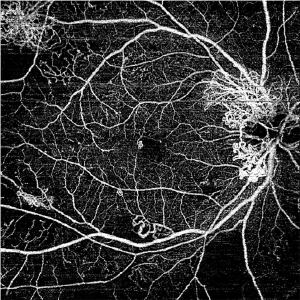 Swept Source OCT Angiography画像