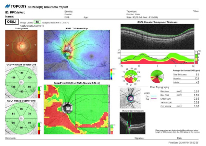 3D Wide Glaucoma レポート