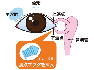 涙点プラグ