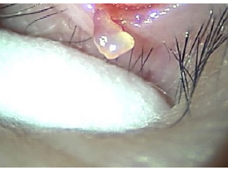 マイボム腺梗塞摘出