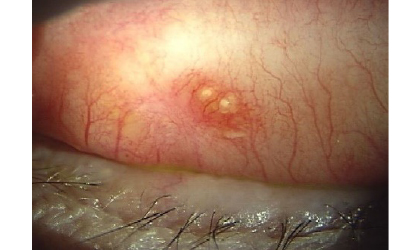 結膜下結石除去