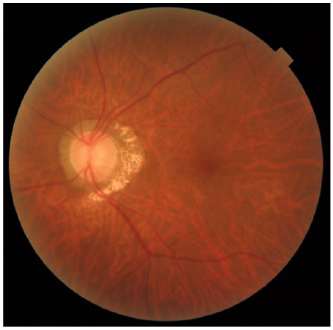 眼底出血と書いてあったら