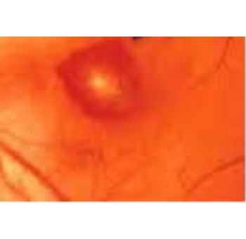 視神経乳頭近傍出血