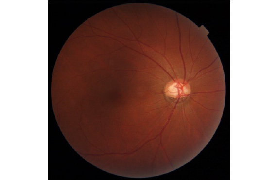 視神経乳頭陥凹拡大、網膜神経線維束欠損と書いてあったら