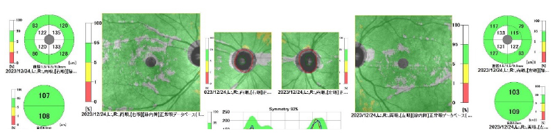 視神経乳頭陥凹拡大、網膜神経線維束欠損と書いてあったら