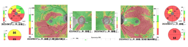 視神経乳頭陥凹拡大、網膜神経線維束欠損と書いてあったら