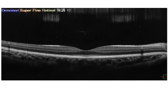 黄斑異常と書いてあったら