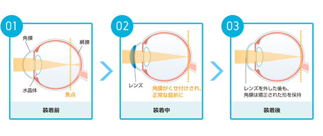 オルソケラトロジーのメリット
